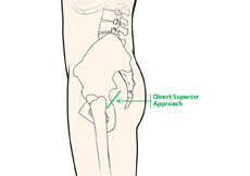 Direct Superior Hip Replacement