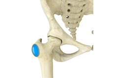 Hip Bursitis