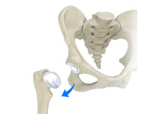 Hip Dislocation