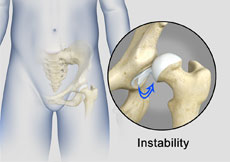 Hip Instability