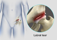 Hip Labral Tear