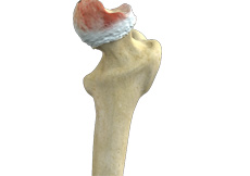 Hip Osteonecrosis