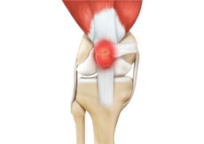 Kneecap Bursitis