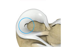 Meniscal Tears