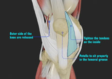 Patellofemoral Instability