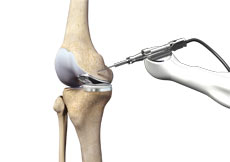 Robotic Knee Replacement