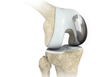 Unicompartmental/Partial Knee Replacement